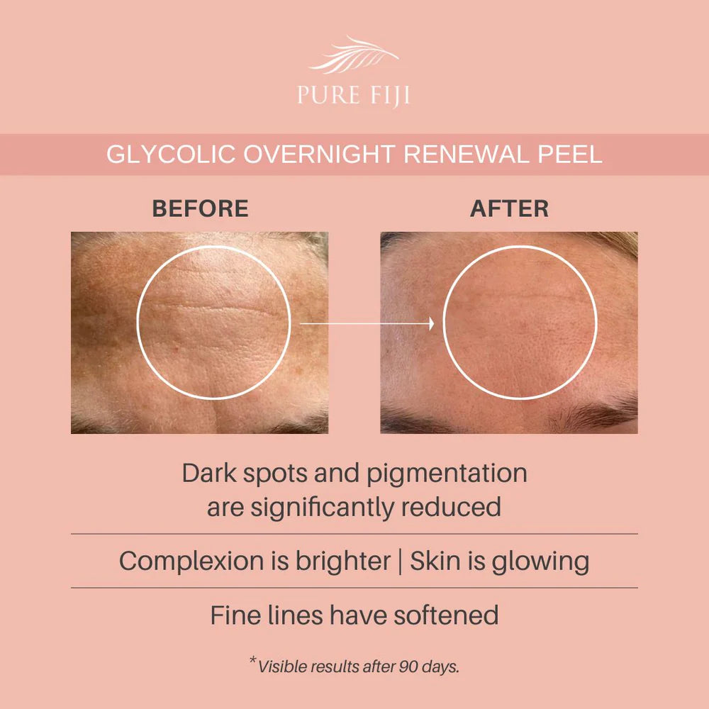 Pure Fiji Glycolic Overnight Renewal Peel With Mandelic + Niacinamide